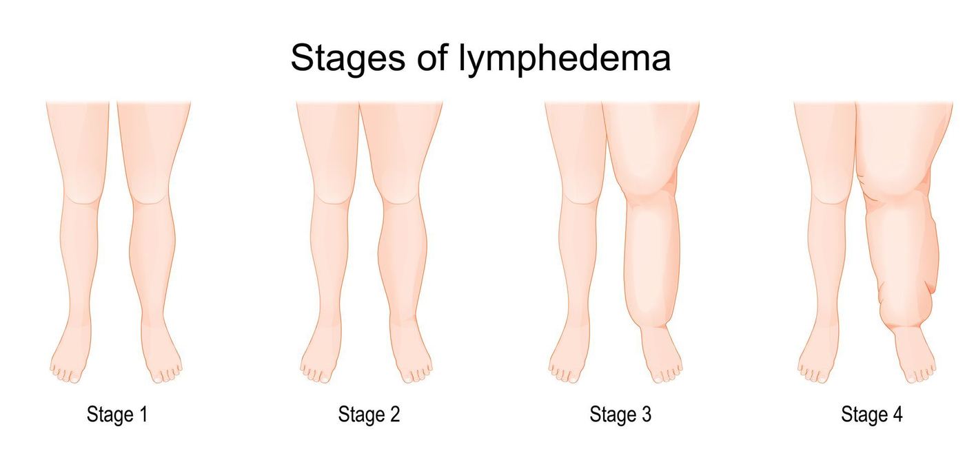 Diagram of the four stages of lymphedema, labelled Stage 1 to Stage 4